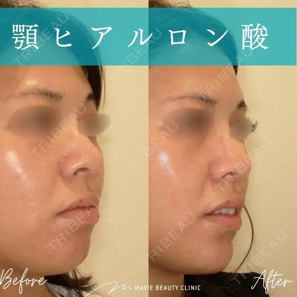 ヒアルロン酸注入（あご） before画像 メイン用