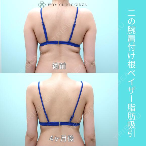 『 二の腕脂肪吸引 』ガッツリ吸引でもタルミなく美しく仕上げる匠の熟練技！ 120日後 メイン用