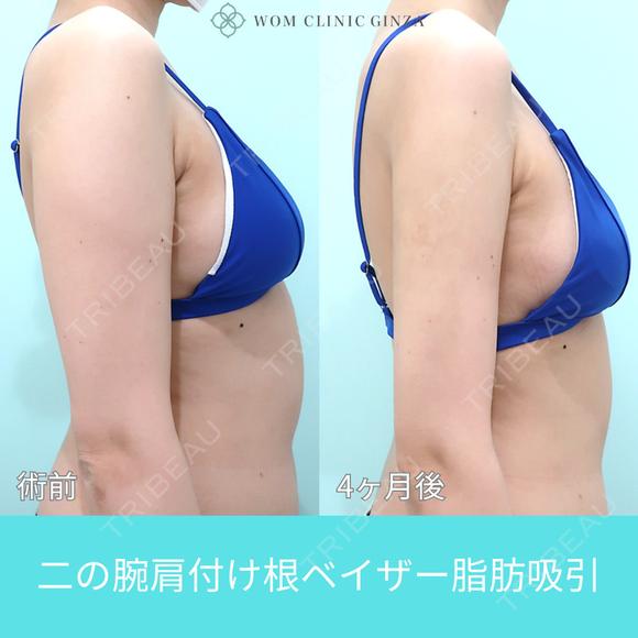 『 二の腕脂肪吸引 』ガッツリ吸引でもタルミなく美しく仕上げる匠の熟練技！ 120日後 メイン用