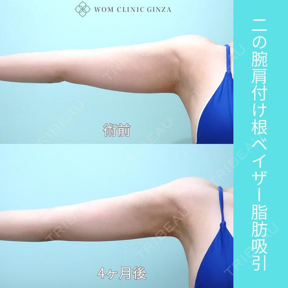 『 二の腕脂肪吸引 』ガッツリ吸引でもタルミなく美しく仕上げる匠の熟練技！ 120日後 メイン用