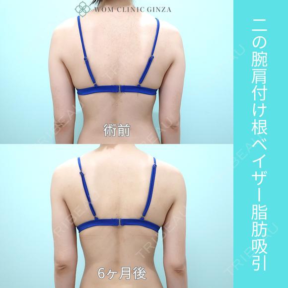 細めの方でも、二の腕と腰からガッツリ吸引、コンデンスリッチ豊胸でお胸もサイズアップ可能 180日後 メイン用