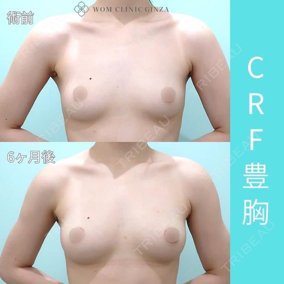 細めの方でも、二の腕と腰からガッツリ吸引、コンデンスリッチ豊胸でお胸もサイズアップ可能 180日後 メイン用