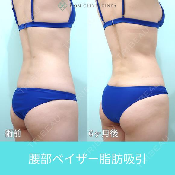 細めの方でも、二の腕と腰からガッツリ吸引、コンデンスリッチ豊胸でお胸もサイズアップ可能 180日後 メイン用
