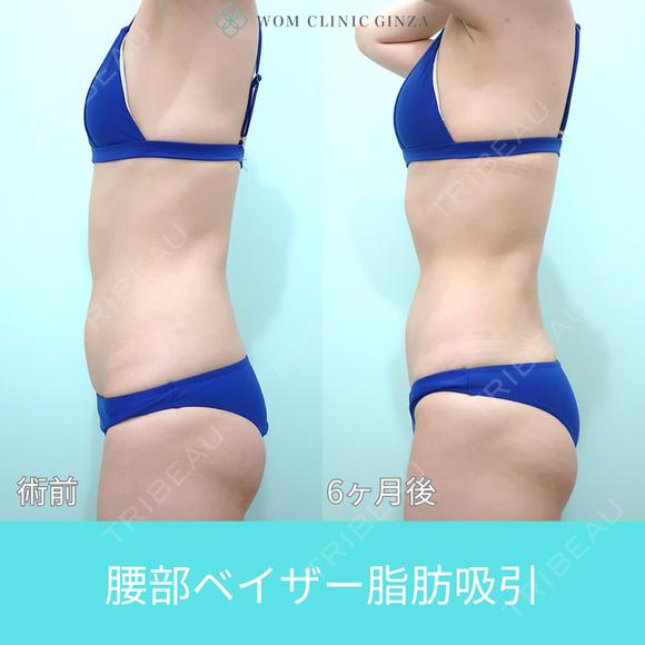 細めの方でも、二の腕と腰からガッツリ吸引、コンデンスリッチ豊胸でお胸もサイズアップ可能 180日後 メイン用