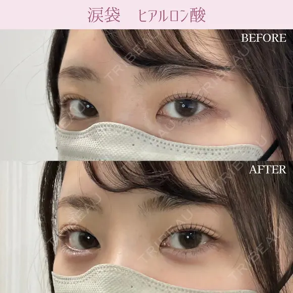 涙袋ヒアルロン酸 before画像 メイン用