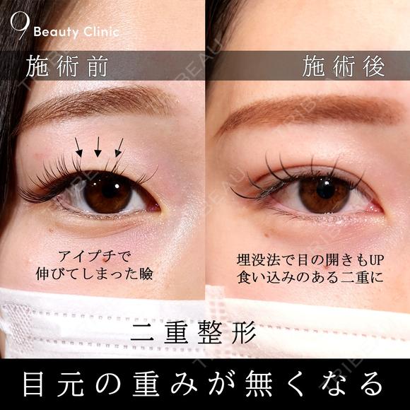 二重埋没 after画像 メイン用