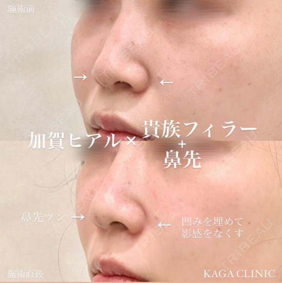 加賀ヒアル×貴族フィラー＋鼻コルメラストラット法 after画像 メイン用