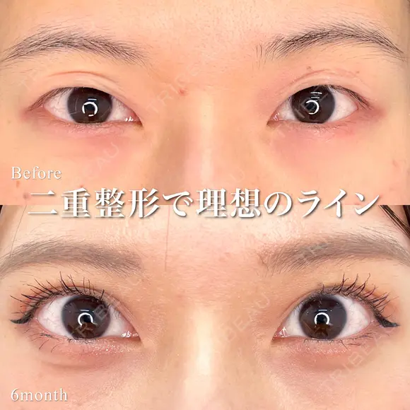 MD式たるみ取り併用全切開二重 before画像 メイン用