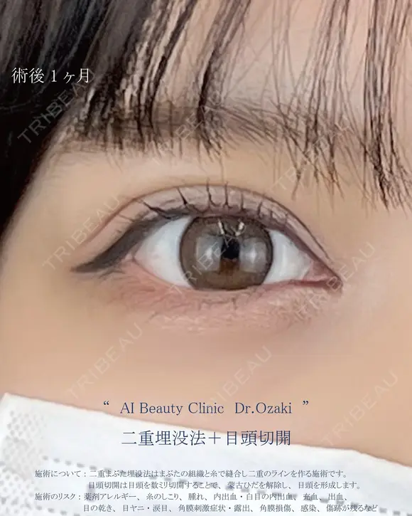 二重埋没法＋目頭切開 after画像 メイン用