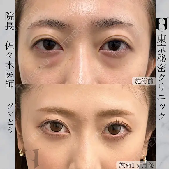 東京秘密クリニックのDr佐々木院長による目の下のクマ取り(下眼瞼脱脂術) before画像 メイン用