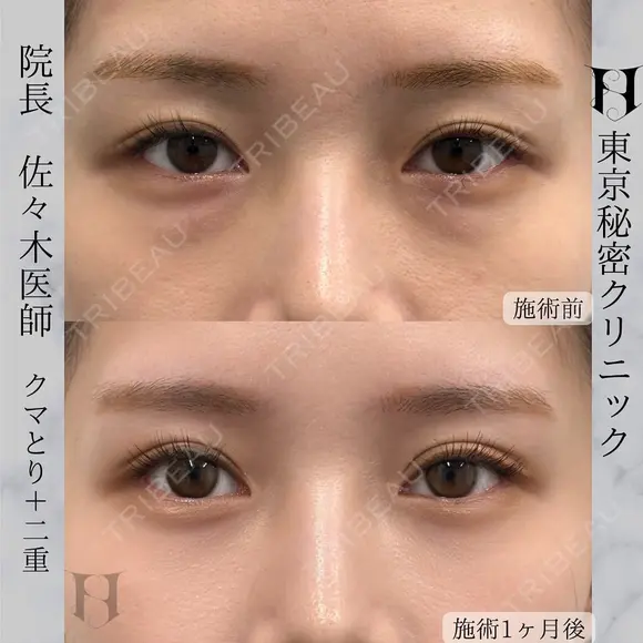 クマ取り(下眼瞼脱脂術)＋目の上の脂肪取り+二重埋没３点 after画像 メイン用