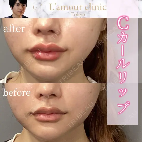 Cカールリップ before画像 メイン用