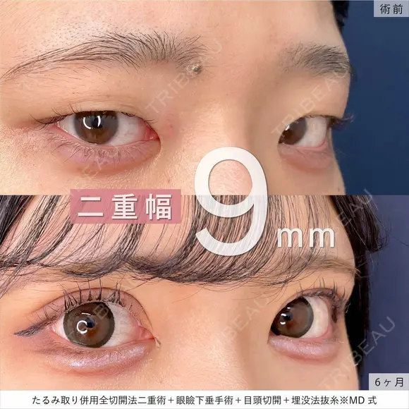 MD式たるみ取り併用全切開法二重術+MD式眼瞼下垂手術＋MD式目頭切開+埋没法抜糸 before画像 メイン用
