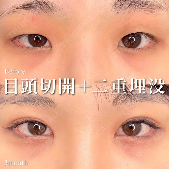目頭切開＋二重埋没 90日後 メイン用