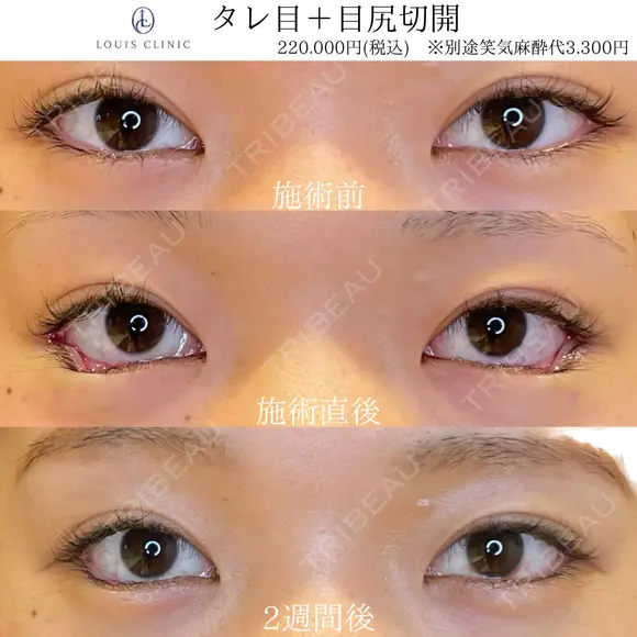 タレ目形成（埋没）+目尻切開 before画像 メイン用