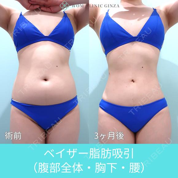 圧倒的自信があります！ 高い技術力の脂肪吸引で腹・腰回りをしっかりクビレさせます！ 90日後 メイン用
