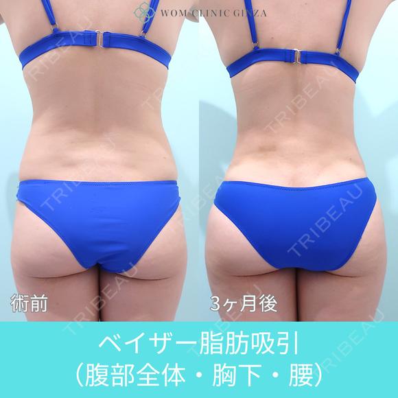 圧倒的自信があります！ 高い技術力の脂肪吸引で腹・腰回りをしっかりクビレさせます！ 90日後 メイン用