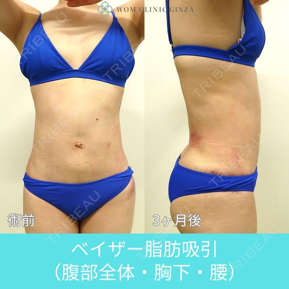 圧倒的自信があります！ 高い技術力の脂肪吸引で腹・腰回りをしっかりクビレさせます！ 1日後 メイン用