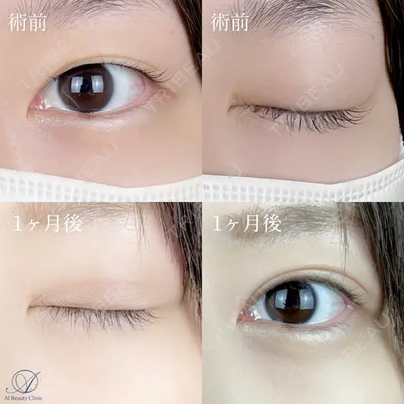 二重埋没法 before画像 メイン用