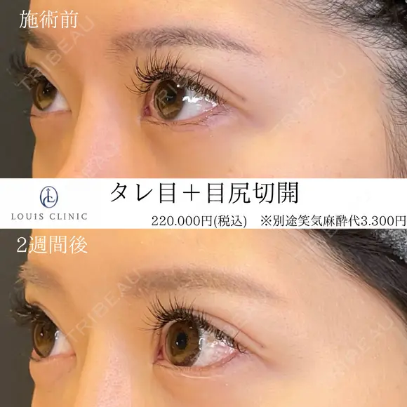 タレ目形成（埋没）+目尻切開 after画像 メイン用