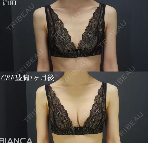 dryuuバスト💓コンデンスリッチ豊胸 after画像 メイン用