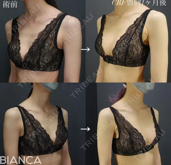 dryuuバスト💓コンデンスリッチ豊胸 after画像 メイン用