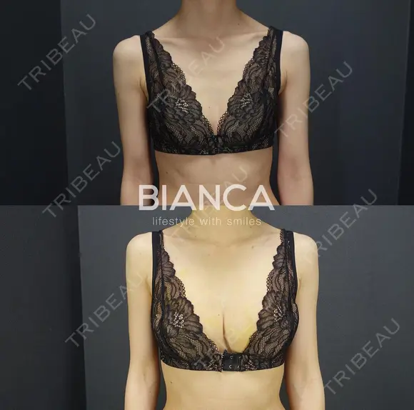 dryuuバスト💕コンデンスリッチ豊胸 before画像 メイン用