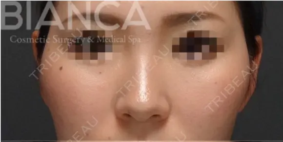 【ヒアルロン酸で鼻先〜鼻筋を整える】 before画像 メイン用
