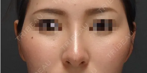【ヒアルロン酸で鼻先〜鼻筋を整える】 after画像 メイン用