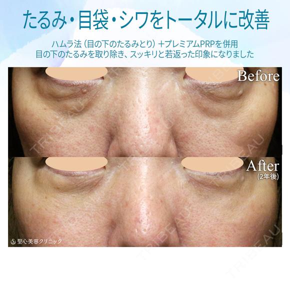 【40代女性・目の下のクマをどう治す？】ハムラ法+α＆プレミアムPRP補正（3年後） before画像 メイン用