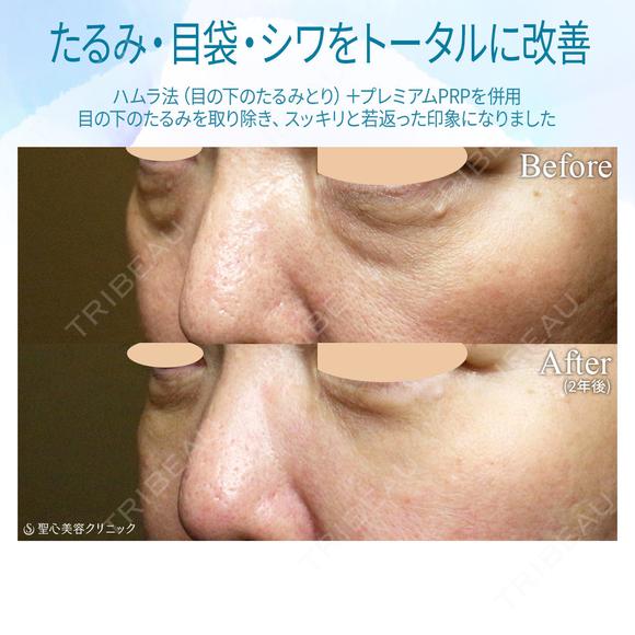 【40代女性・目の下のクマをどう治す？】ハムラ法+α＆プレミアムPRP補正（3年後） after画像 メイン用