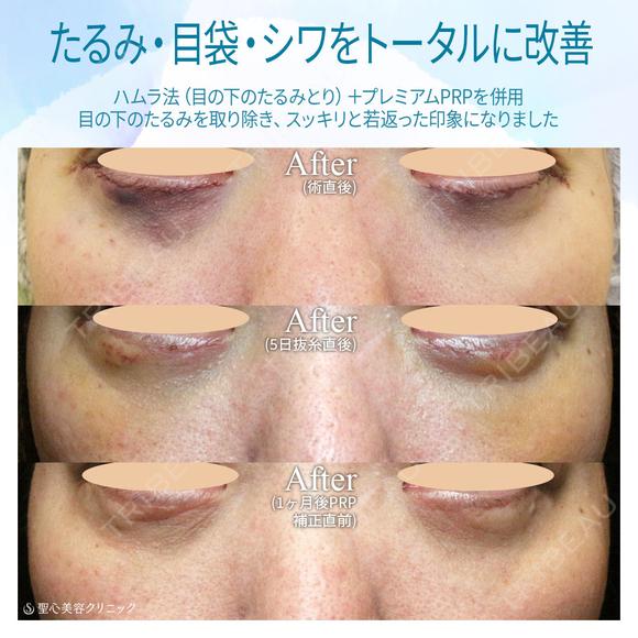 【40代女性・目の下のクマをどう治す？】ハムラ法+α＆プレミアムPRP補正（3年後） after画像 メイン用