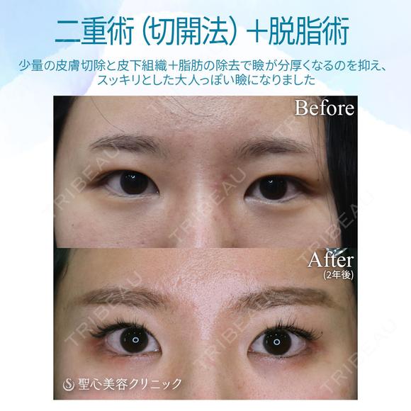 【20代女性・スッキリした二重まぶたへ】二重術（切開法）＋脱脂術（2年後） before画像 メイン用