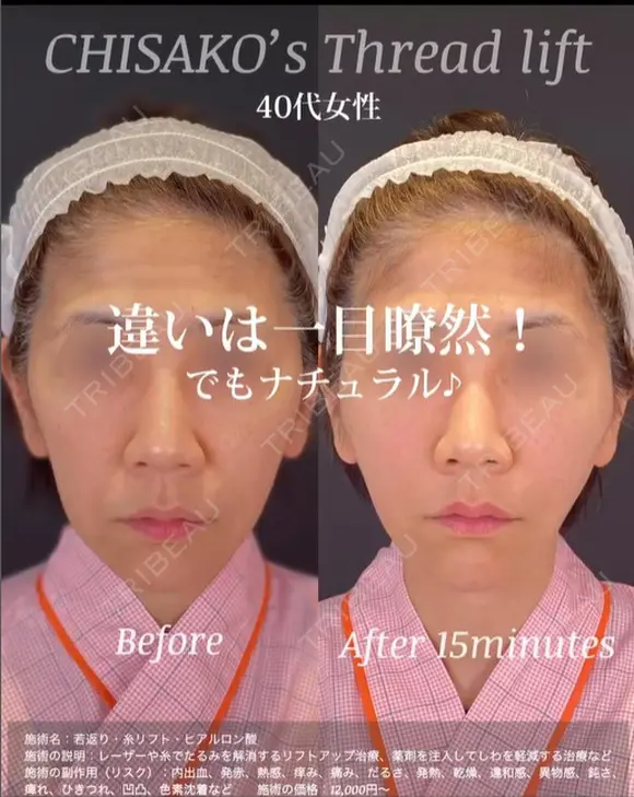 糸リフトでほうれい線すっきり・口元も・たるみケア after画像 メイン用