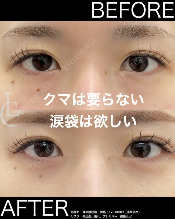クマ取り＆涙袋ヒアル！ 30日後 メイン用