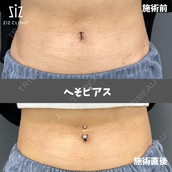 人生初ピアス！で、へそピアス！！夏にキラキラおへそのアクセサリー♪ after画像 メイン用