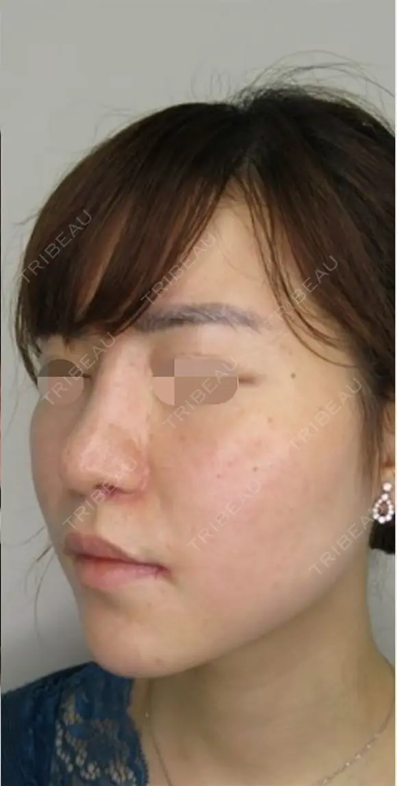 メーラーファット+ジョールファット除去 after画像 メイン用