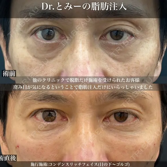 窪み目改善！とみー先生によるコンデンスリッチ脂肪注入 before画像 メイン用