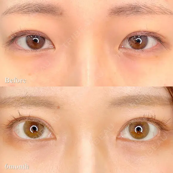 MD式たるみ取り併用全切開+眼瞼下垂＋MD式目頭切開 before画像 メイン用