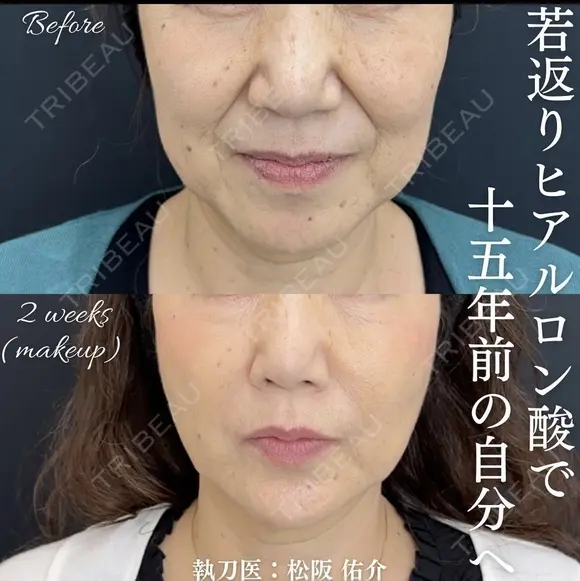 ヒアルロン酸 before画像 メイン用