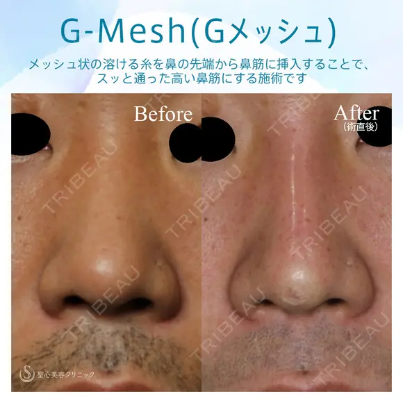 【30代男性・Gメッシュで綺麗な鼻筋を手に入れる！！】Gメッシュ（術直後） before画像 メイン用