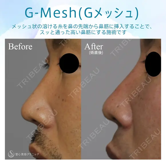 【30代男性・Gメッシュで綺麗な鼻筋を手に入れる！！】Gメッシュ（術直後） 0日後 メイン用