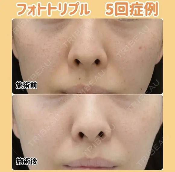 薄いシミやくすみを改善！フォトトリプル✨ before画像 メイン用