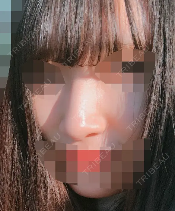 鼻の手術 before画像 メイン用