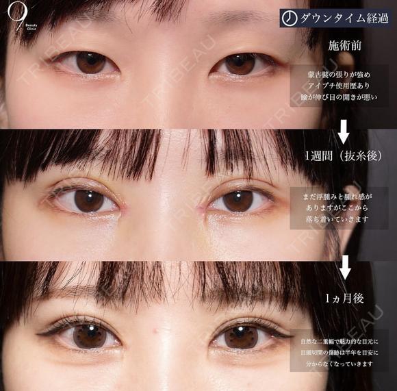 二重埋没 before画像 メイン用