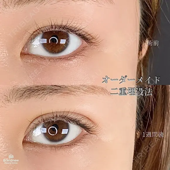 二重まぶた埋没法 after画像 メイン用