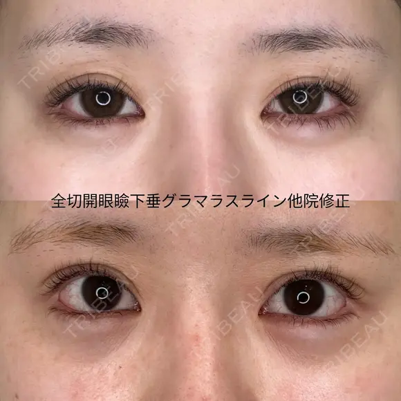 全切開＋眼瞼下垂修正＋グラマラスライン結膜切開（全て他院修正） before画像 メイン用