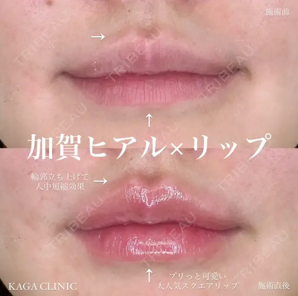 加賀ヒアル×リップ after画像 メイン用