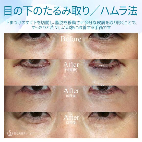 【40代女性・理想のオージーカーブをつくる】ハムラ法+α 単独（2年後） after画像 メイン用