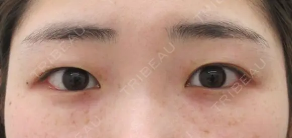 埋没4点留め+目頭切開術+クマ治療(下眼瞼脱脂術) before画像 メイン用
